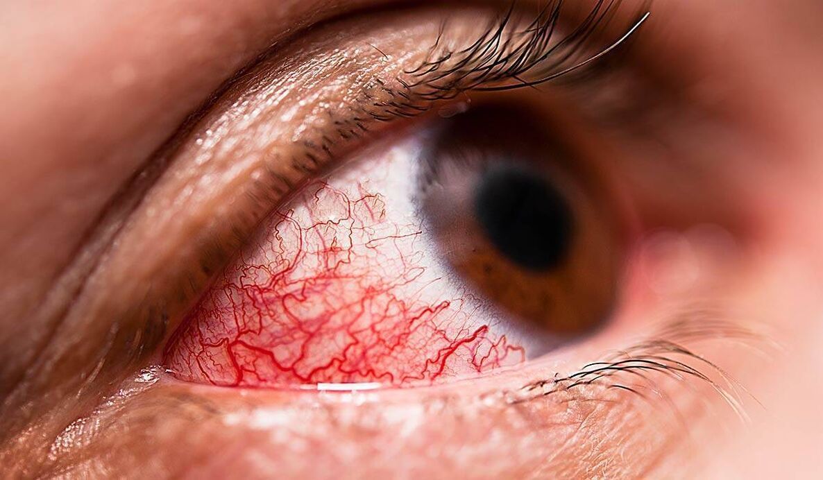 Retinopatia cukrzycowa jest jednym z późnych powikłań cukrzycy